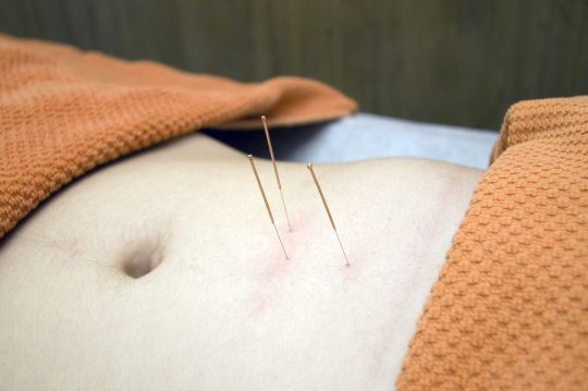 L'acupuncture a des effets bénéfiques sur la fertilité